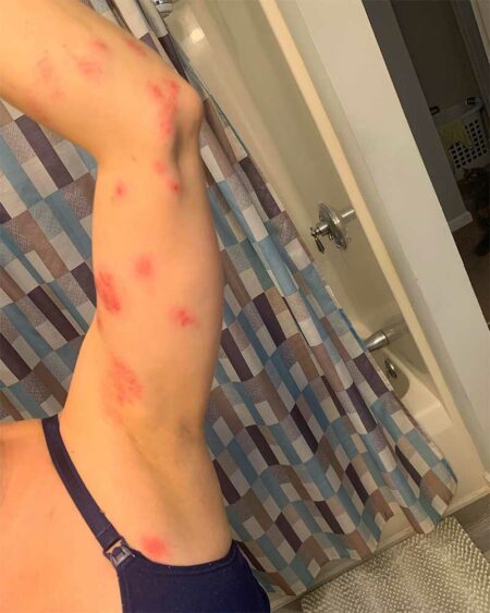 What should I do if I have shingles?